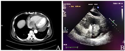 Malignant Gastrointestinal Neuroectodermal Tumor in the Right Heart: A Report of an Extremely Rare Case Presenting With a Cardiac Mass